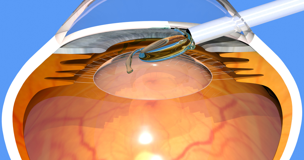 Cataract Surgery  or Refractive Lens Exchange (RLE)