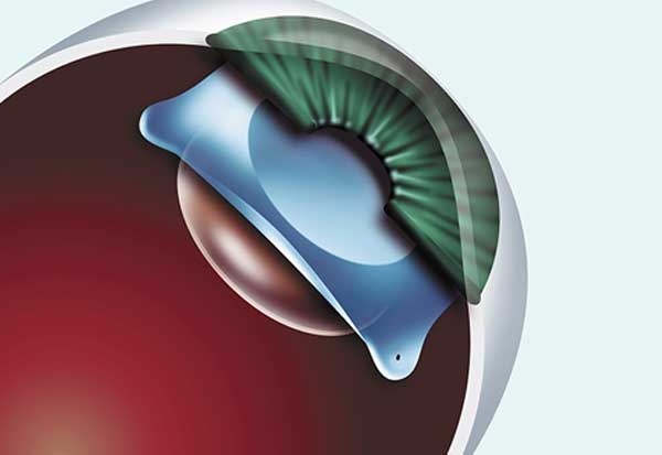 Implantable Contact (Collamer) Lens